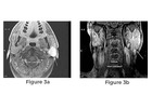 Parotid Tumor Surgery